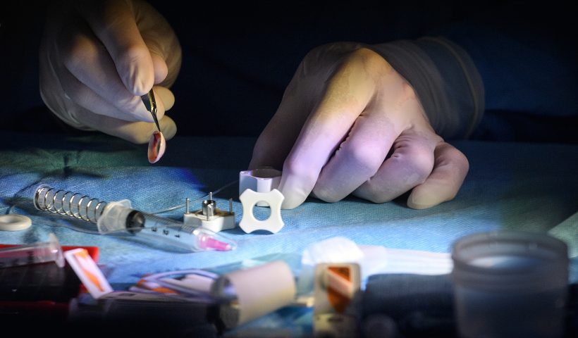 TRUJILLO, PERU - APRIL 20: Dr Mark Mannis removes the rest of the donor rim after removing the cornea using a trephine tool during a transplant operation on Reis-Buckler syndrome patient Diana, aged 17, onboard the Orbis Flying Eye Hospital on April 20, 2018 in Trujillo, Peru. Reis-Buckler corneal dystrophy is a rare genetic condition which causes the Bowman's layer of the cornea to disintegrate. Diana's mother Rosa has the same syndrome and has struggled with sight loss since the age of nine. After suffering with the condition since the age of three, Diana was chosen for surgery during a programme run by Orbis, the ophthalmic training organisation. Founded in 1982 by ophthalmologist David Paton, Orbis trains eyecare teams across Africa, Asia and Latin America to improve the standard of eyecare in the region. As well as working in local hospitals, the charity also has a self-sufficient surgical unit on the Orbis Flying Eye Hospital, a converted McDonald-Douglas MD10 aircraft. (Photo by Leon Neal/Getty Images)