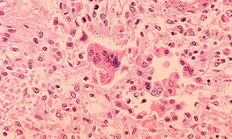 1972: In this handout from the Centers for Disease Control and Prevention (CDC), a histopathology of measles pneumonia is seen in this microscope image from 1972. Measles outbreaks have been reported throughout the U.S., with the latest reported February 5, 2015 at a daycare in suburban Chicago where as many as five children under the age of one have been infected. (Photo by CDC via Getty Images)